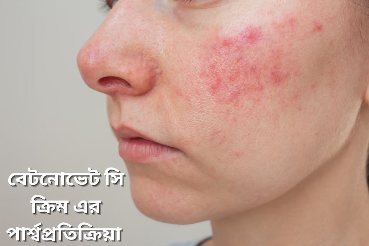 Betnovate C Cream side effect